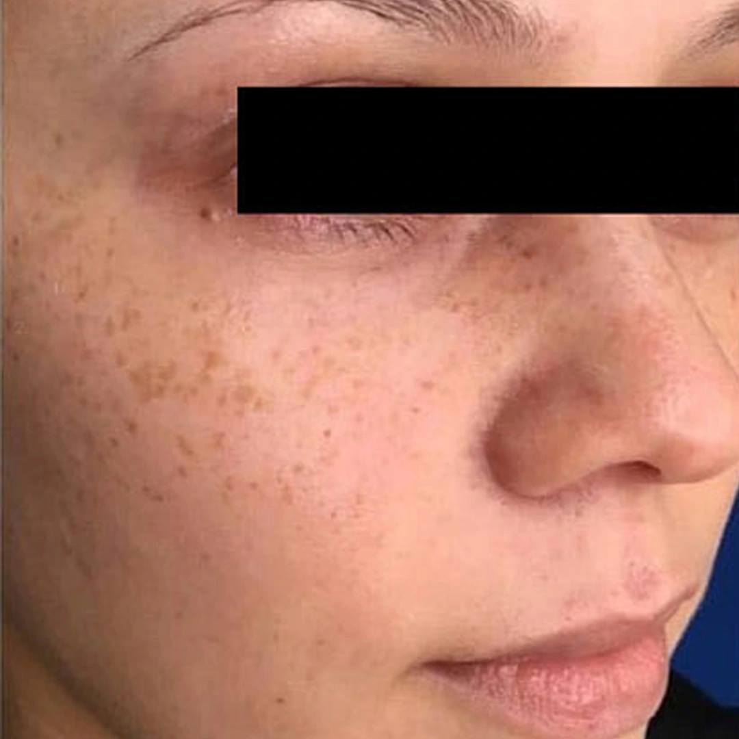Advanced IPL treatment results
