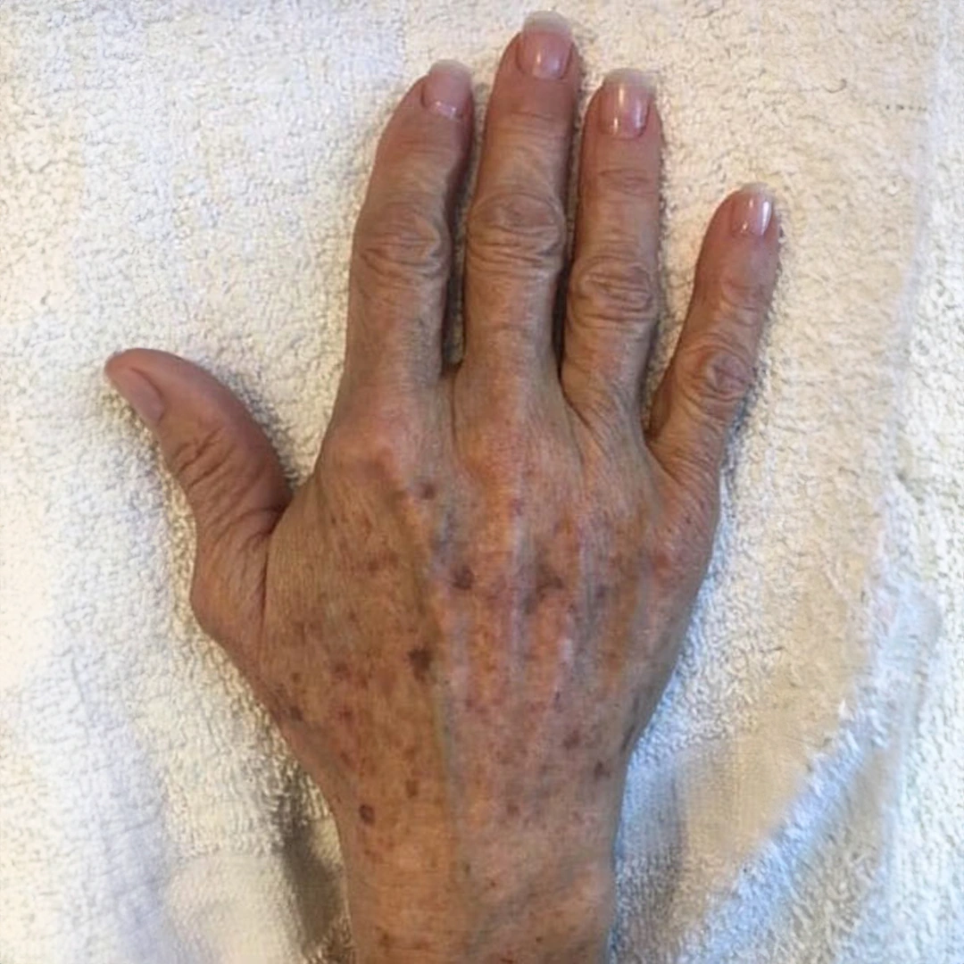 Advanced IPL treatment hand results